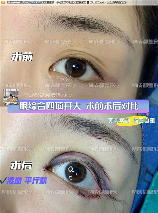成都眼修复整形医院