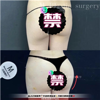 丰臀术前术后对比