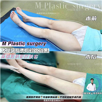 大腿吸脂整形术前术后对比