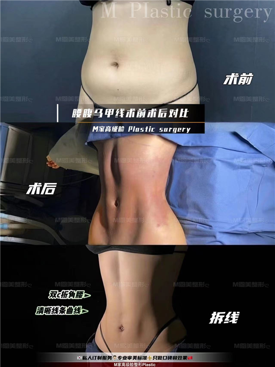 腰腹马甲线术前术后对比