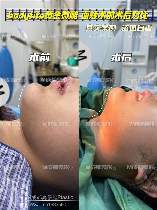 成都吸脂整形医院