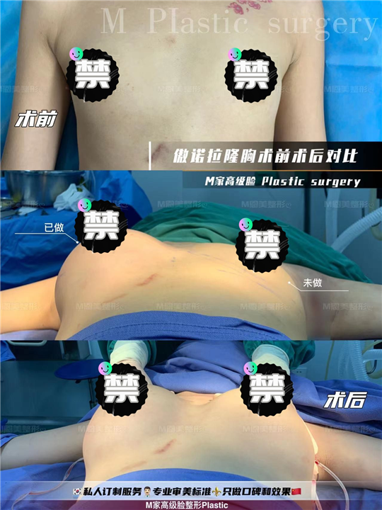 傲诺拉隆胸术前术后对比