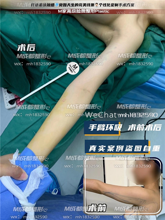 成都吸脂整形医院