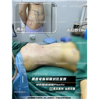 成都腰腹吸脂精雕