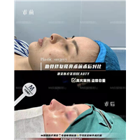 成都肋骨鼻修复隆鼻