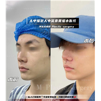 人中缩短人中窝鼻翼拆线