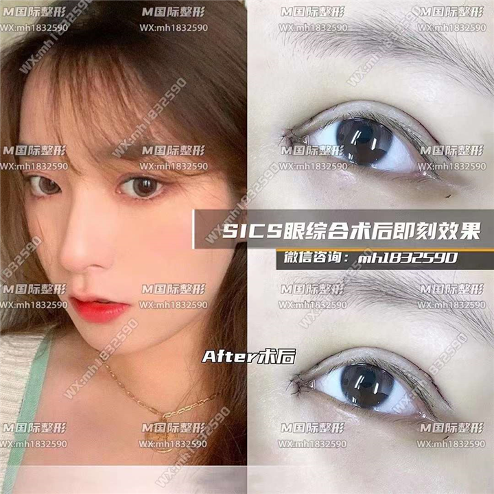 成都眼修复整形医院