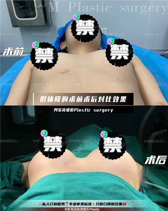 假体隆胸术前术后对比