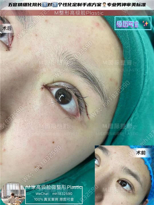 成都眼修复整形医院