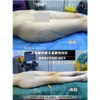 大小腿环吸手术对比