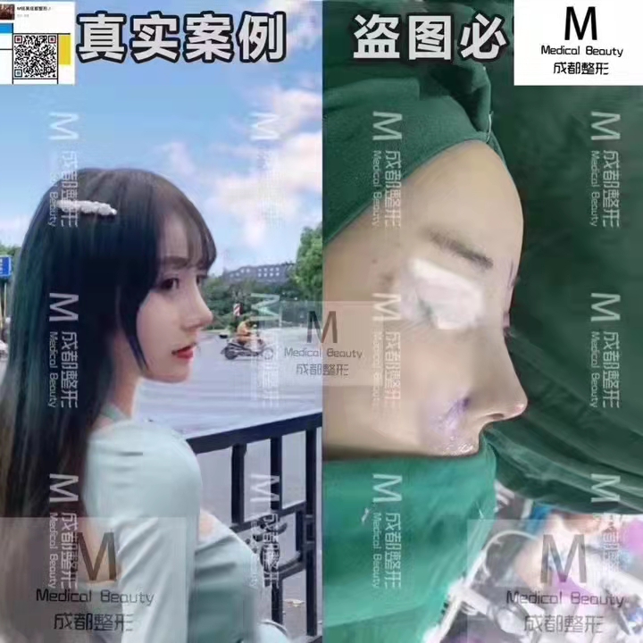 成都鼻综合整形