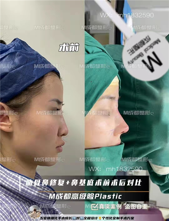 肋骨鼻修复鼻基底整形