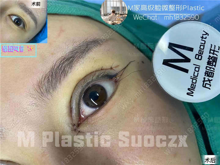 成都眼修复整形医院