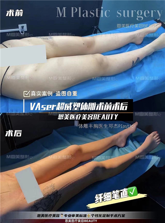 VAser超威塑体雕术前术后对比
