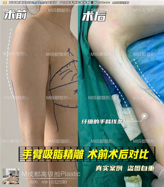成都吸脂整形医院