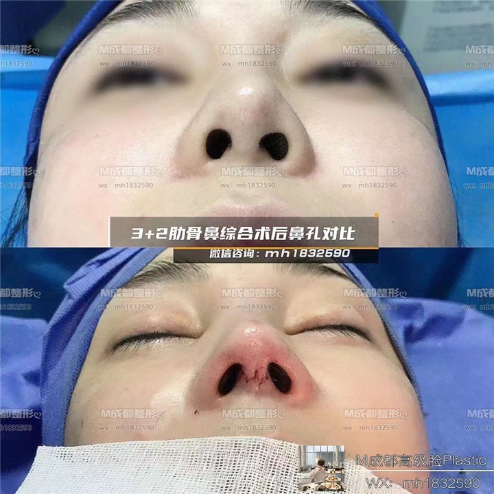 成都鼻综合整形