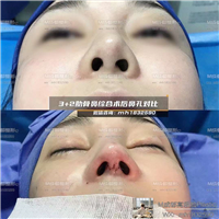 成都鼻综合整形