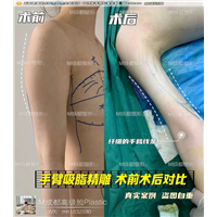 成都吸脂整形医院