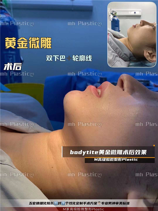 成都吸脂整形医院