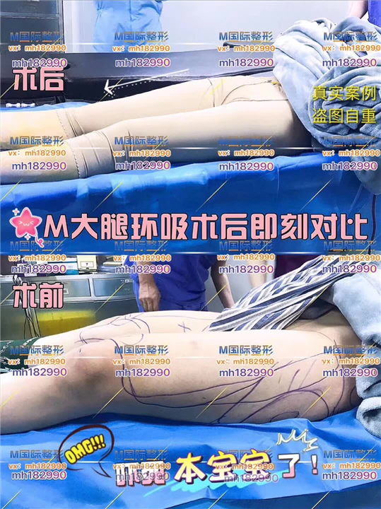 成都吸脂整形医院