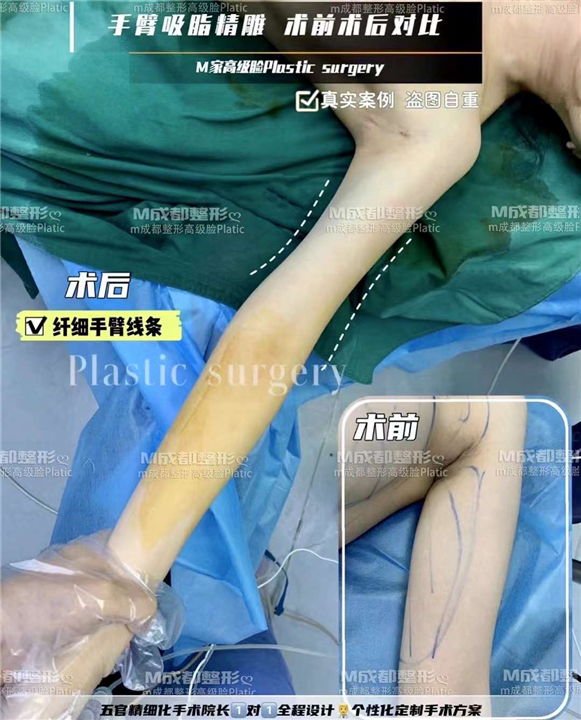 成都吸脂整形医院