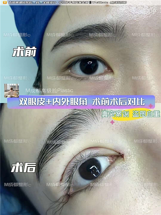 成都眼修复整形医院