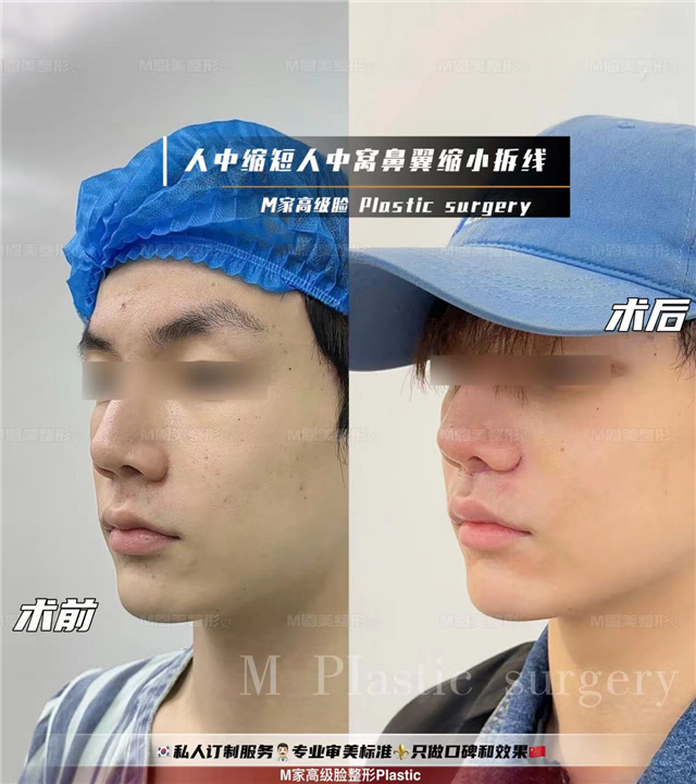 人中缩短人中窝鼻翼拆线