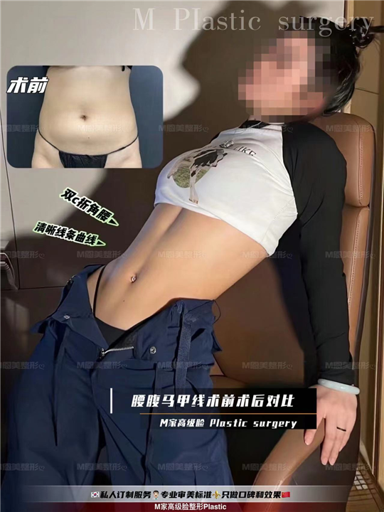 恩美腰腹马甲线前后手术对比