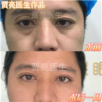贾亮双眼皮案例宽