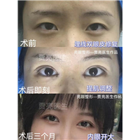 眼皮下垂，双眼皮变成三眼皮还能恢复吗？