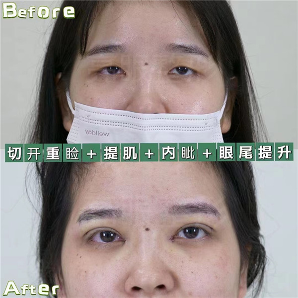 为什么要选择我们的眼区眼袋术式和眼袋修复术式