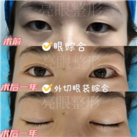 反复贴双眼皮贴，会造成眼部皮肤松弛吗？