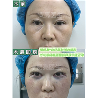 上眼皮的松弛，做提眉好还是做双眼皮好？