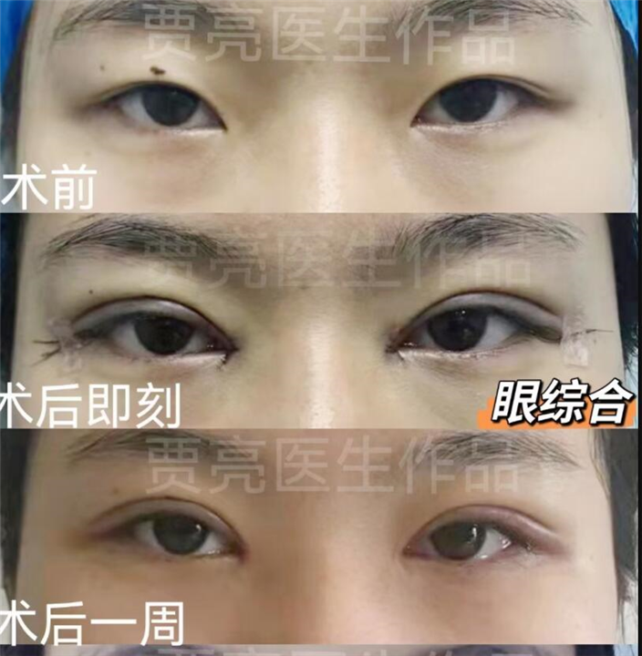 双眼皮术后有肉条要如何去除，双眼皮失败了还能修复吗？