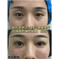 眼袋的出现是眼部衰老的表现之一