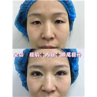 郑州眼部整形专家贾亮