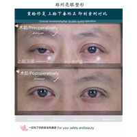 什么情况才算是眼睛松了，应该做了？