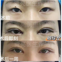 双眼皮术后有肉条要如何去除，双眼皮失败了还能修复吗？