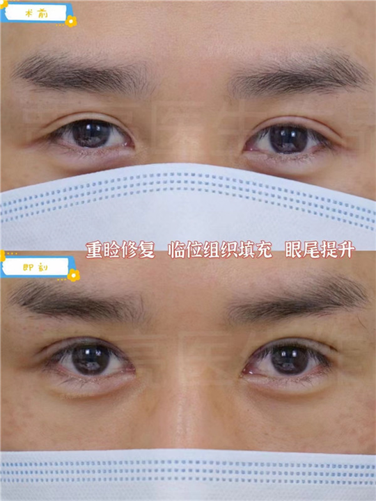 贾亮医生眼型矫正及双眼皮失败修复