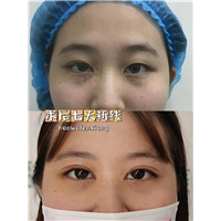 割完双眼皮留下疤痕就是疤痕体质了吗