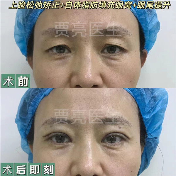 眼部手术后的康复期、注意事项