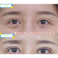 为什么说双眼皮修复手术要比双眼皮手术难度大很多呢?