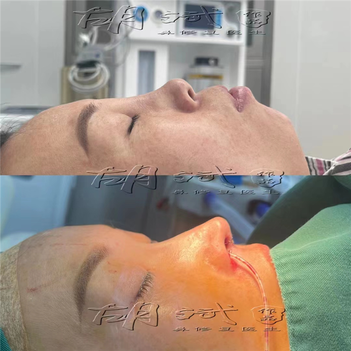 隆鼻带来的错误说法鼻子高了就一定好看
