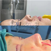 郑州胡斌鼻部整形手术隆出您的美鼻