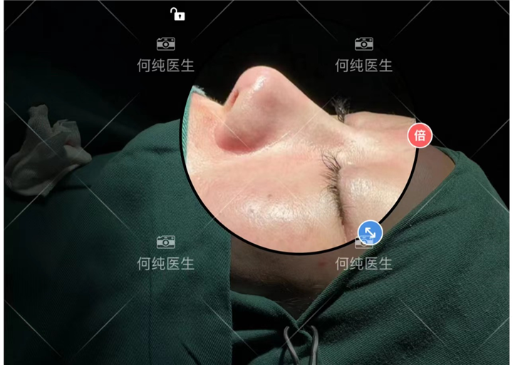 何纯医生分享什么时候做鼻修复比较好？