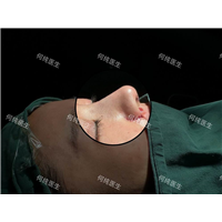 广州高难度鼻修复