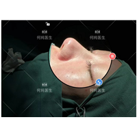 何纯医生分享什么时候做鼻修复比较好？
