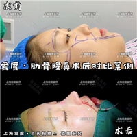 上海鼻整形医生