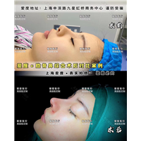 上海肋骨鼻整形专家 