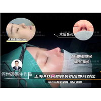 上海何世硕鼻整形：说说鼻部适合人群有哪些